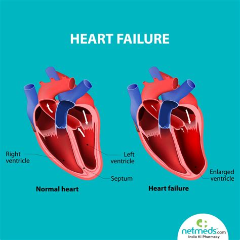 symptoms of left ventricular dysfunction